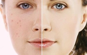 کرم-ضد-جوش-درمالوگ-dermalog-anti-acne-cream